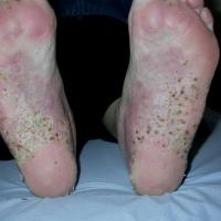 Palmoplantar pustular psoriasis