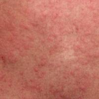 Cholinergic urticaria