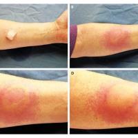 Cold urticaria