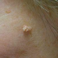 Filiform wart
