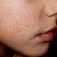 Plane warts (copied with kind permission - Dermatoweb)