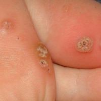Plantar warts (copied with kind permission - Dermatoweb)