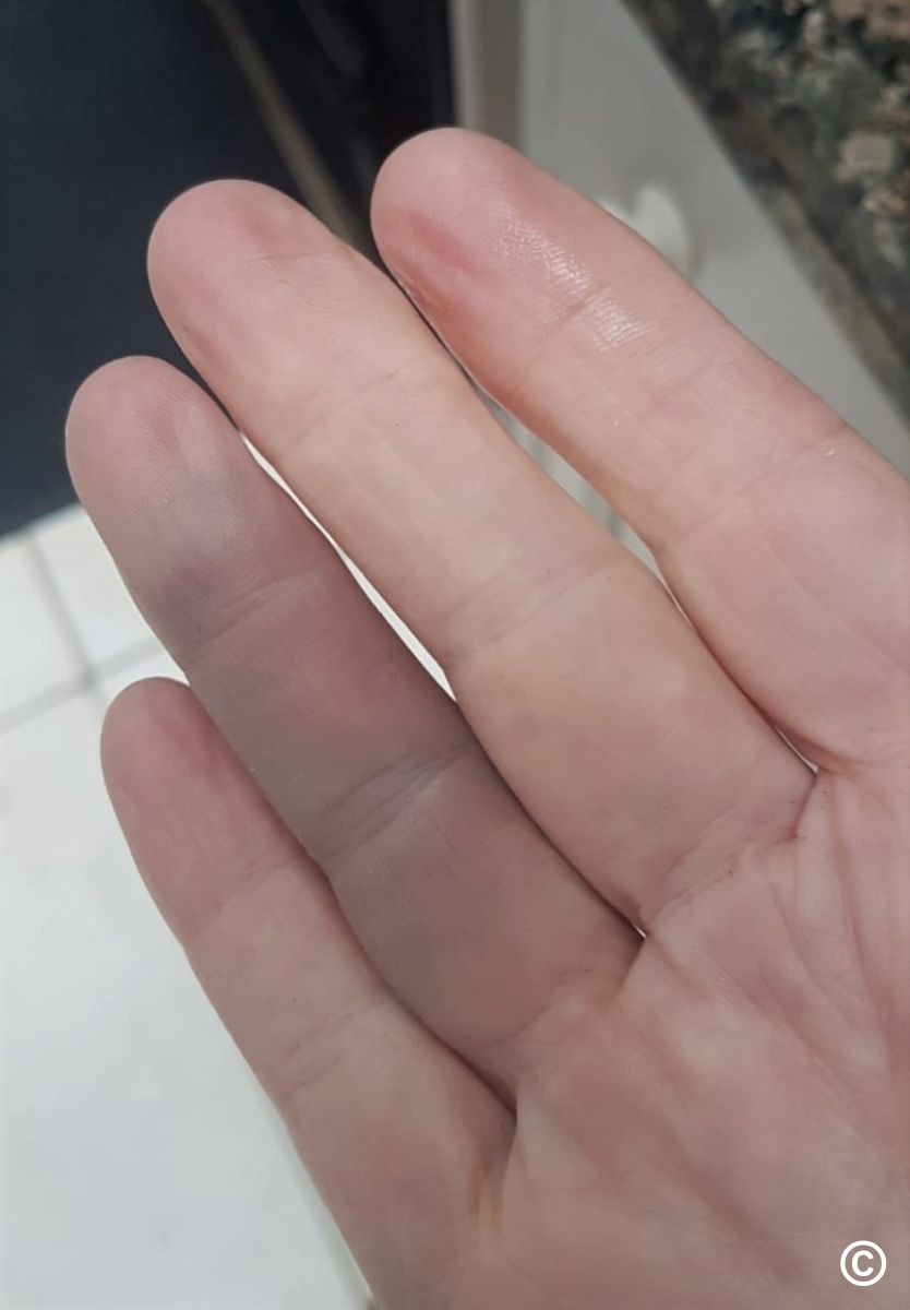 Recently, I got a new ring that slides right on my finger and can be spun,  indicating that it fits, but after a few hours my finger is swollen. Why is  this? -