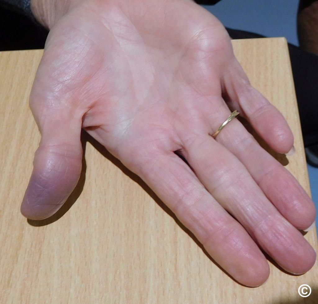 Unexplained bruising on foot nhs store emergencydentistry
