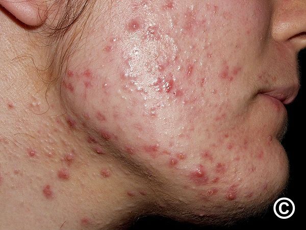 polycystic ovarian syndrome acne