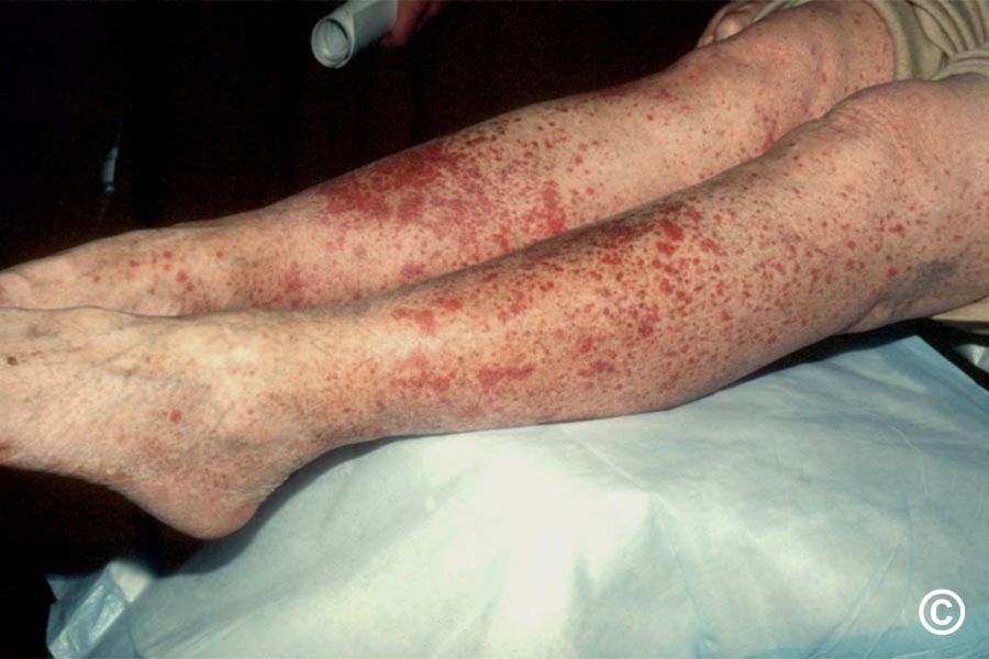Drug rashes: mild to moderate Drug rashes: mild to moderate