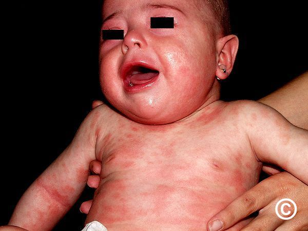 Atopic eczema sales