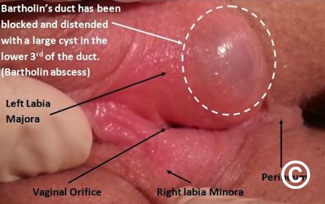 Bartholin&#039;s cysts