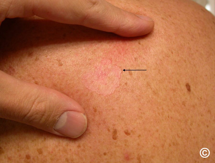 superficial-basal-cell-carcinoma