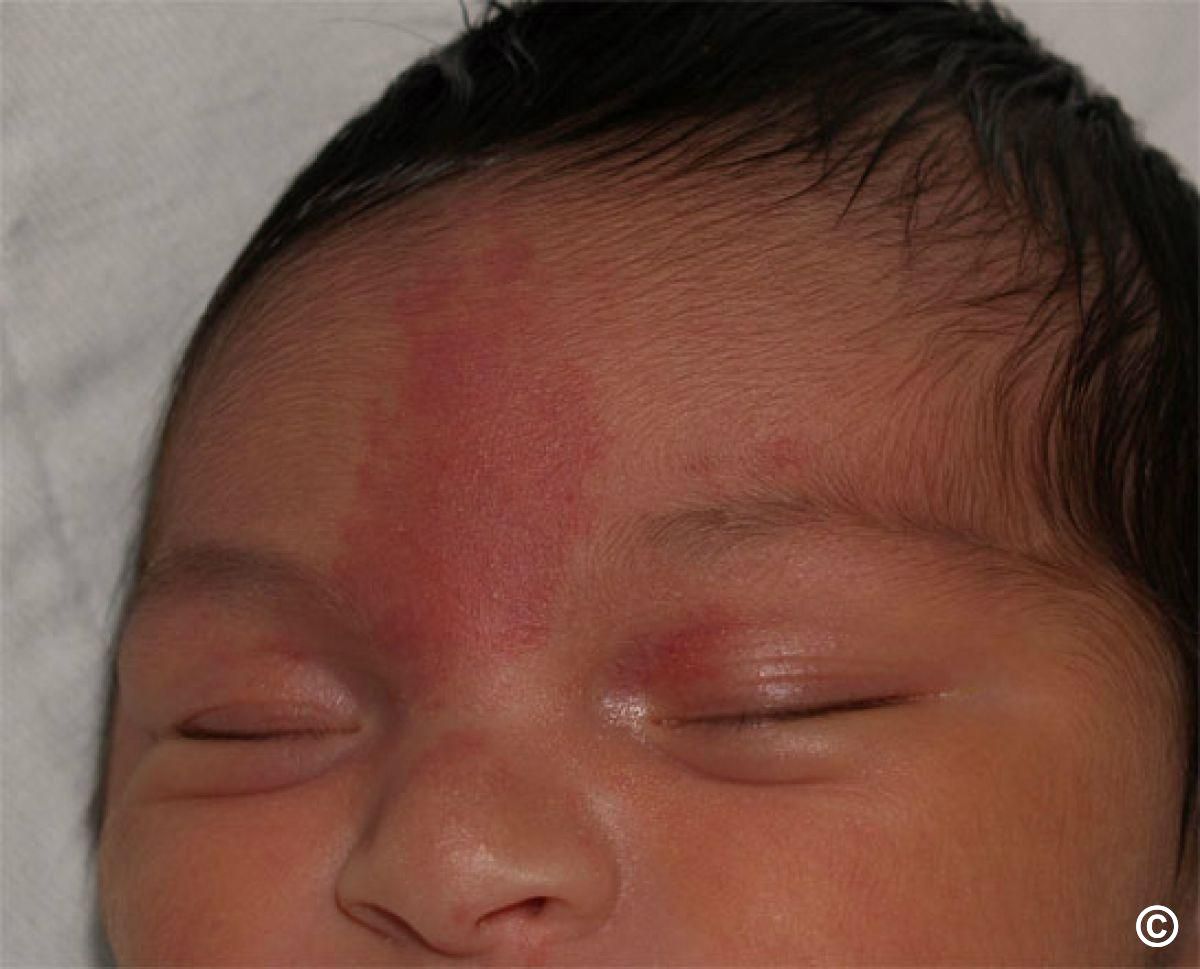 Birthmarks an overview