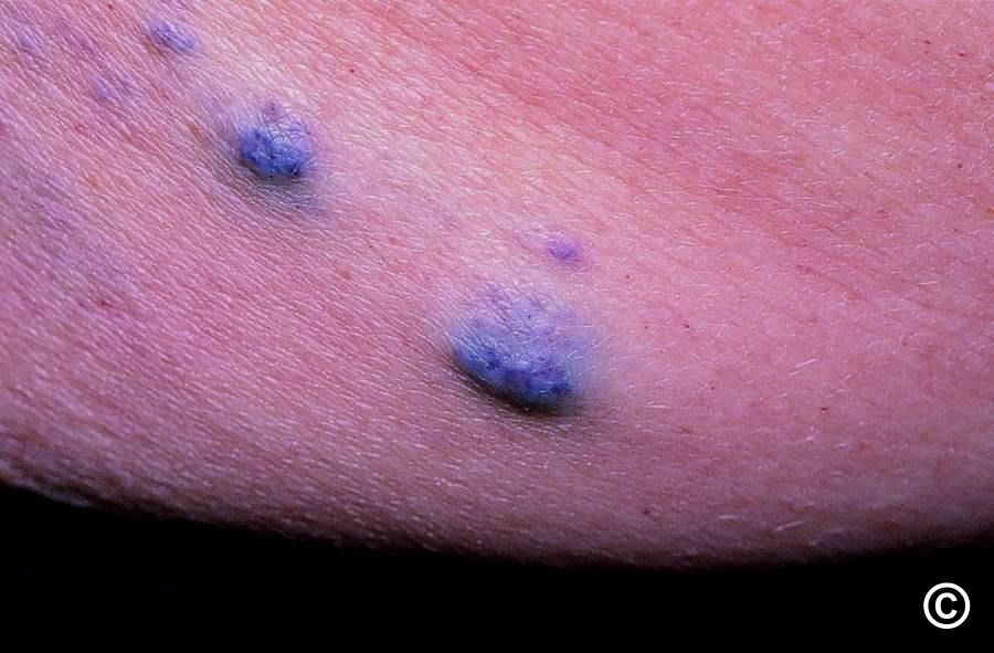 The Blue Rubber Bleb Naevus syndrome