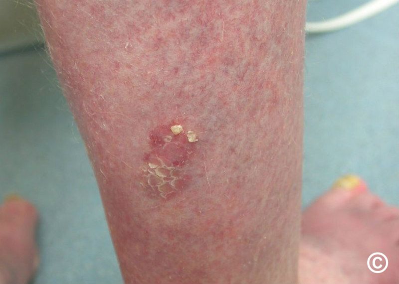 Bowen 039 S Disease