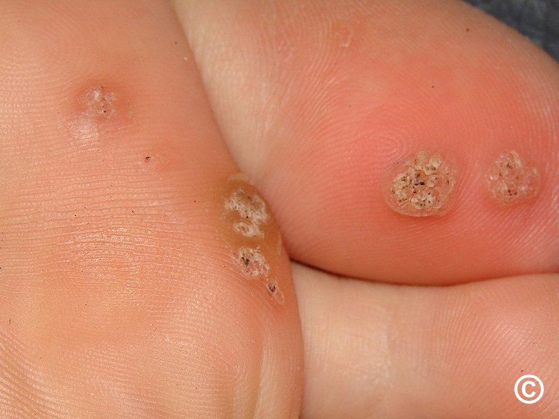 Corn on finger sales treatment