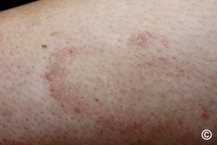 Pigmented Purpuric Dermatoses Syn Capillaritis