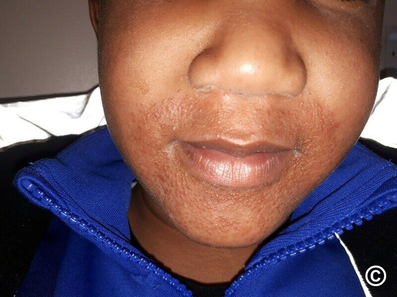 Childhood granulomatous periorificial dermatitis syn. facial Afro