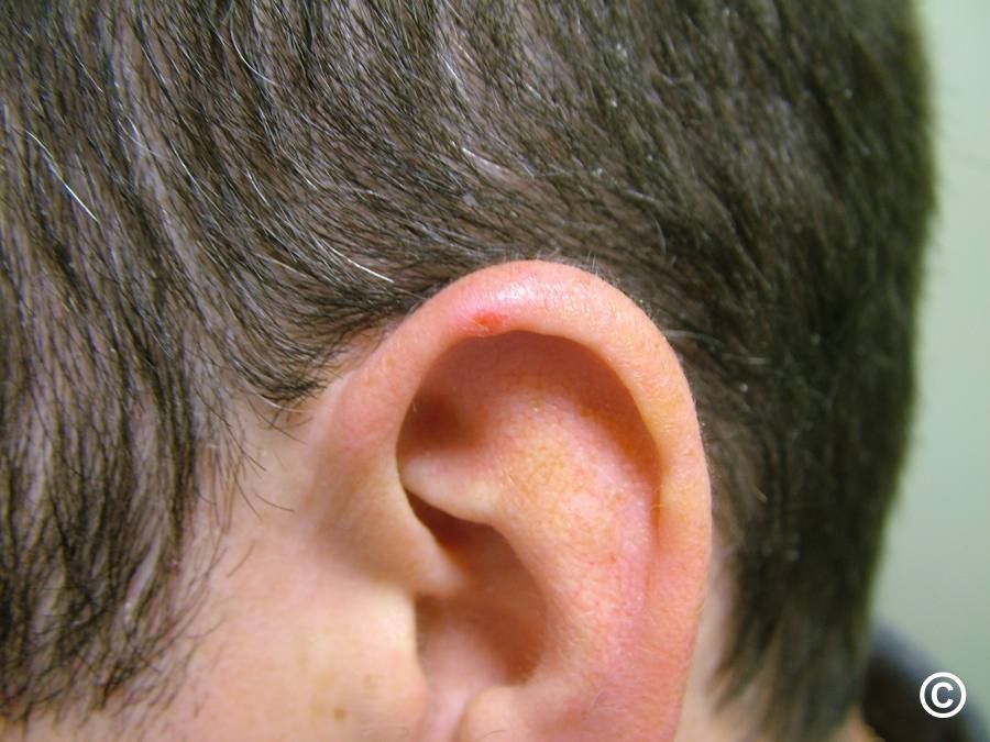 Chondrodermatitis nodularis helicis