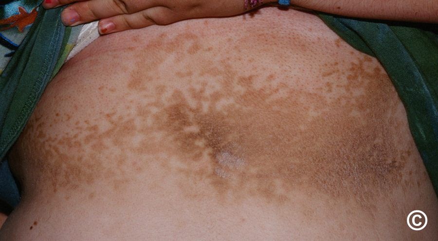 confluent and reticulated papillomatosis derm net)