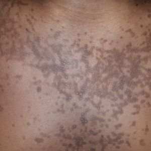 confluent and reticulated papillomatosis vs tinea versicolor)