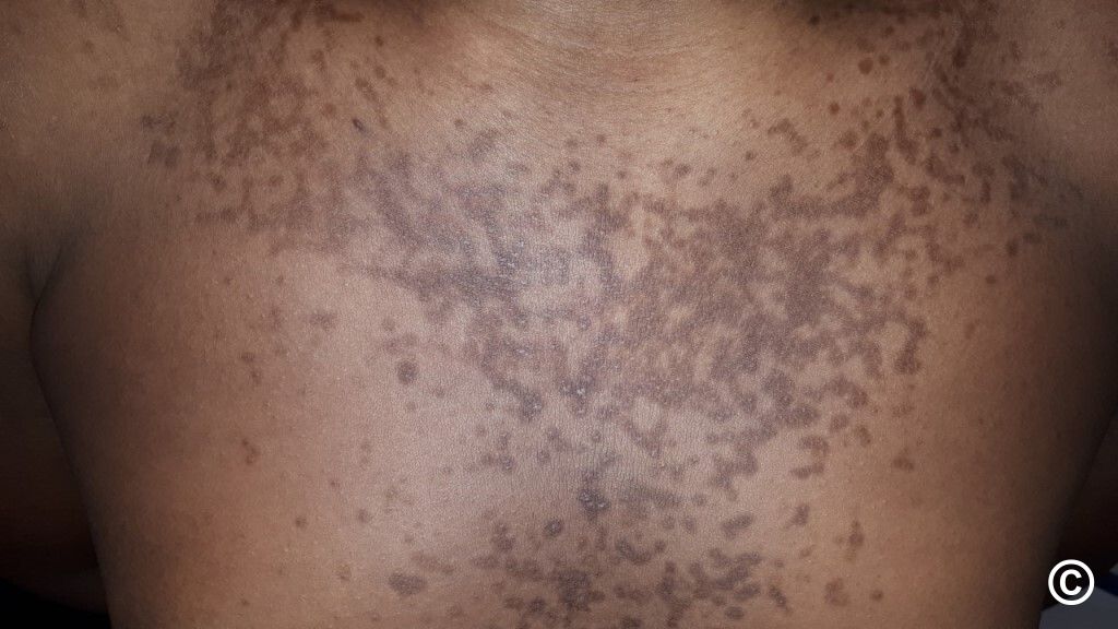 confluent and reticulated papillomatosis neck