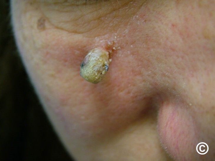 actinic keratosis horn