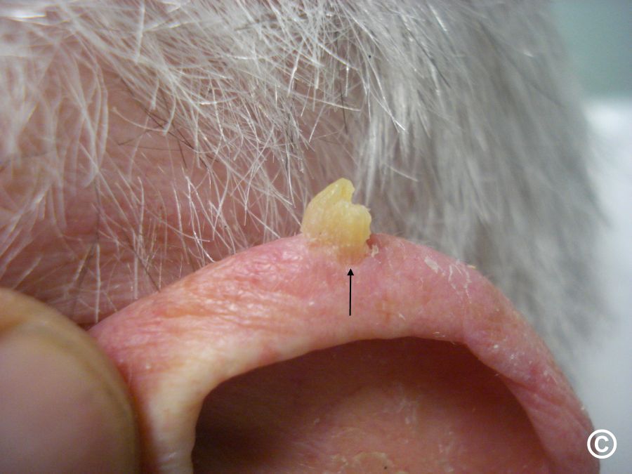 actinic keratosis horn