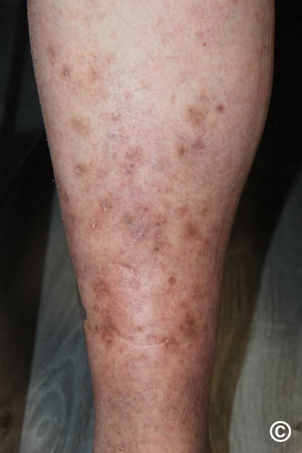 Treatment of pretibial myxoedema with pentoxifylline in: Orvosi Hetilap Volume Issue 43 ()