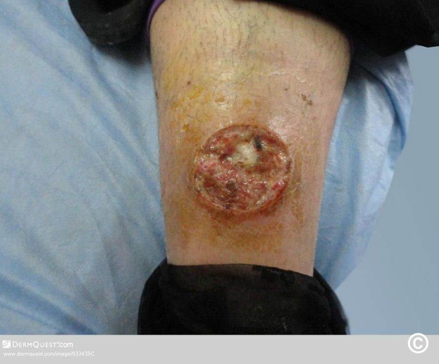 Ecthyma gangrenosum shop