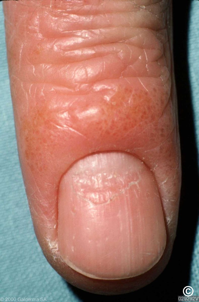 Dyshidrotic Eczema Nail