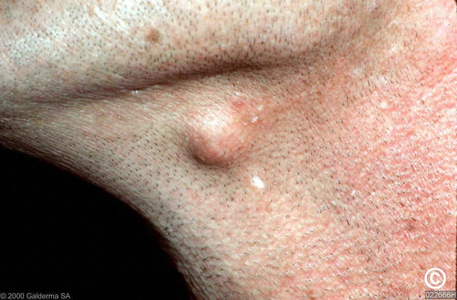 Infected sebaceous cyst