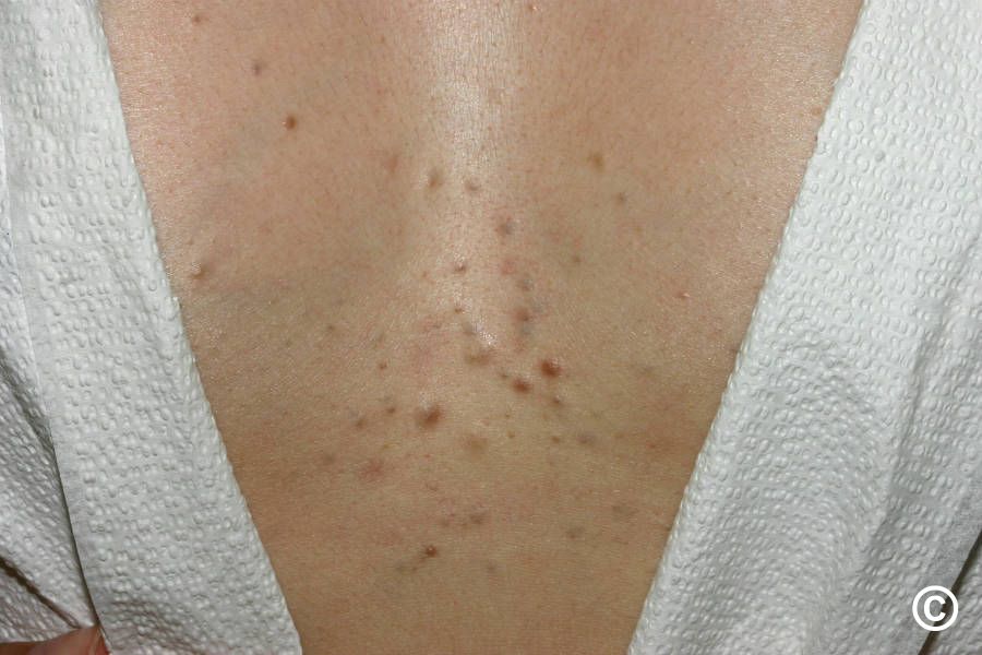 Eruptive vellus hair cysts Eruptive vellus hair cysts