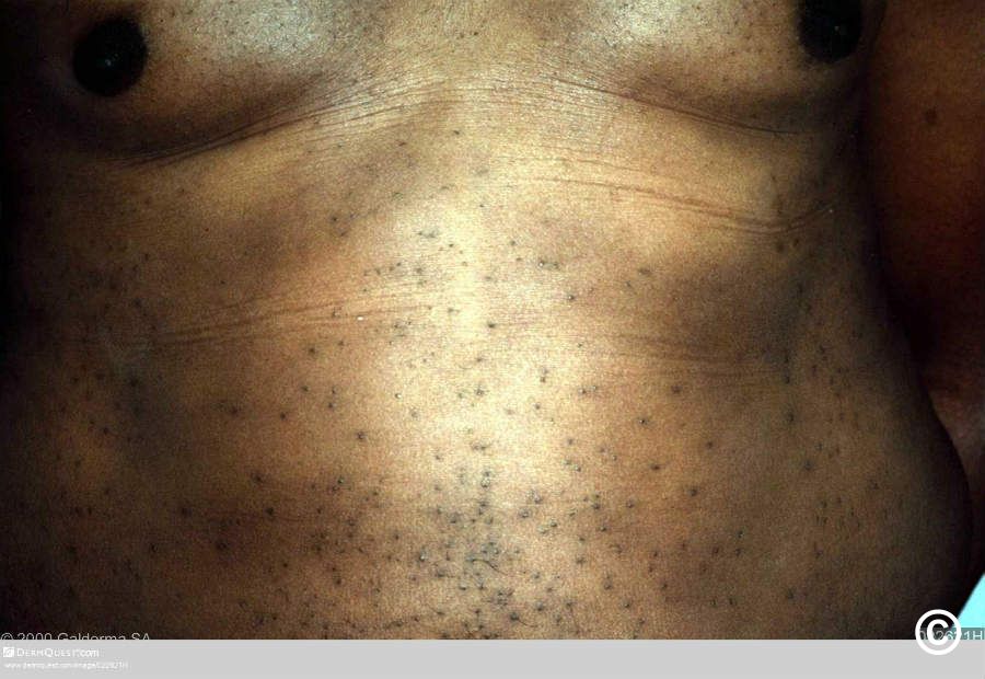 Eruptive vellus hair cysts Eruptive vellus hair cysts