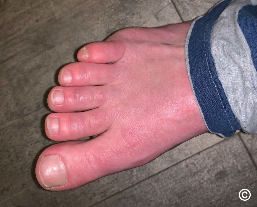 Erythromelalgia