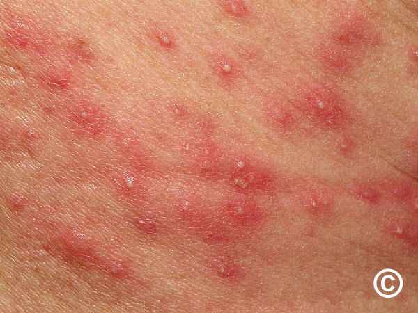 Folliculitis and furuncles / carbuncles (boils) Folliculitis and furuncles / carbuncles (boils)