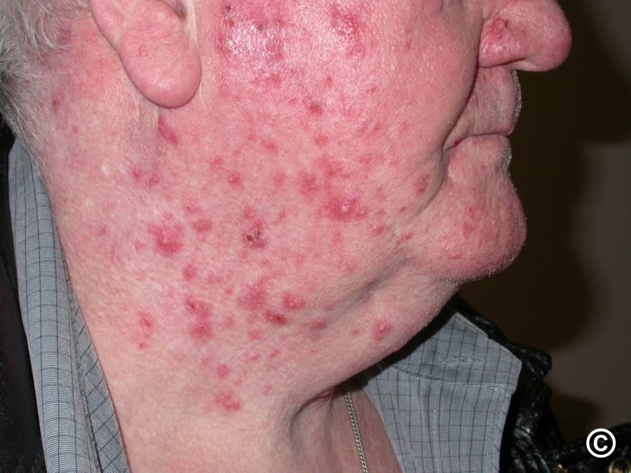 Bacterial Folliculitis On Face