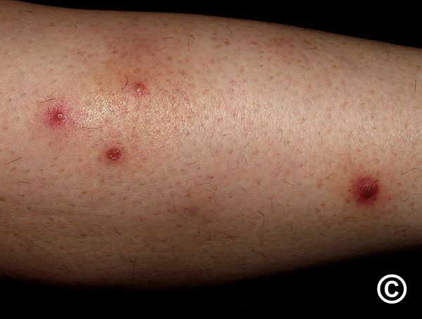 Folliculitis and furuncles / carbuncles (boils)