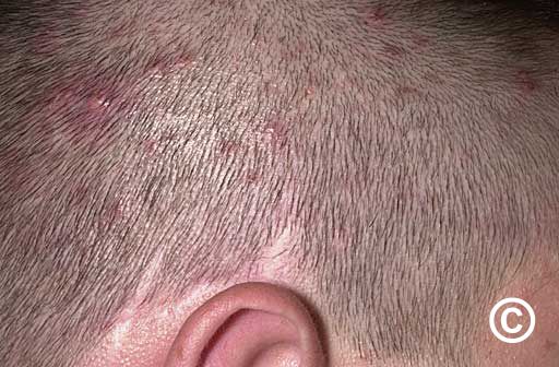 Folliculitis (infected hair follicle) Treatment | Houston Dermatologist |  The Woodlands Texas