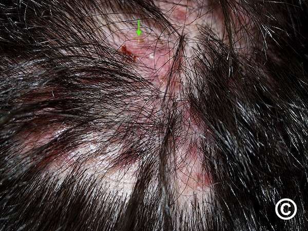 Scalp Folliculitis Treatment – Almond Clear