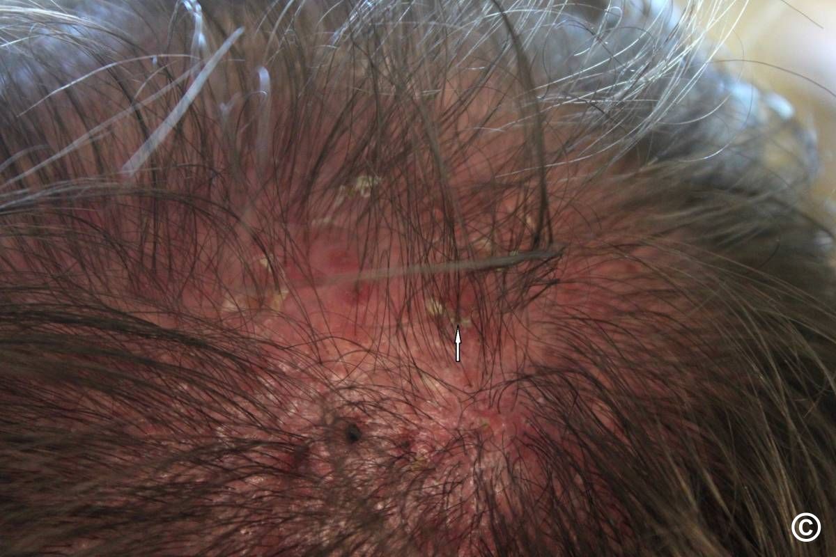 Folliculitis decalvans
