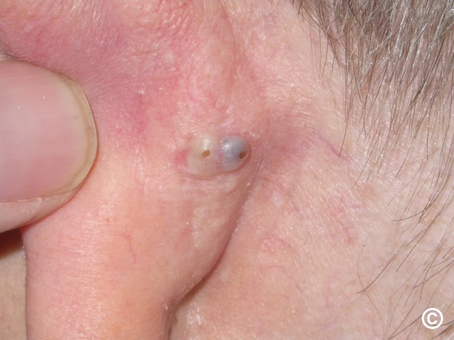 Blackheads behind ears 2021 youtube best sale