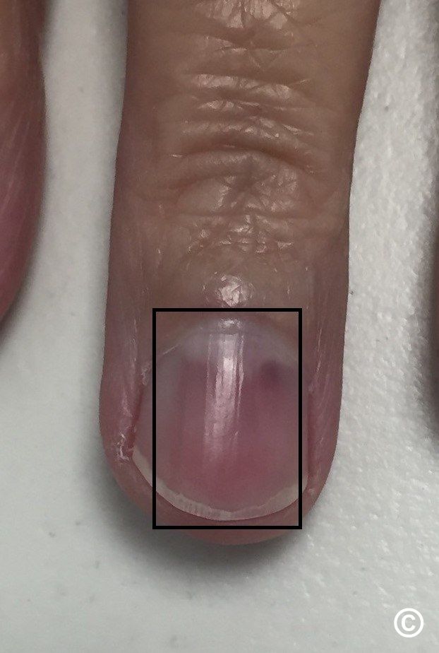 Painful nail with longitudinal erythronychia | MDedge Family Medicine