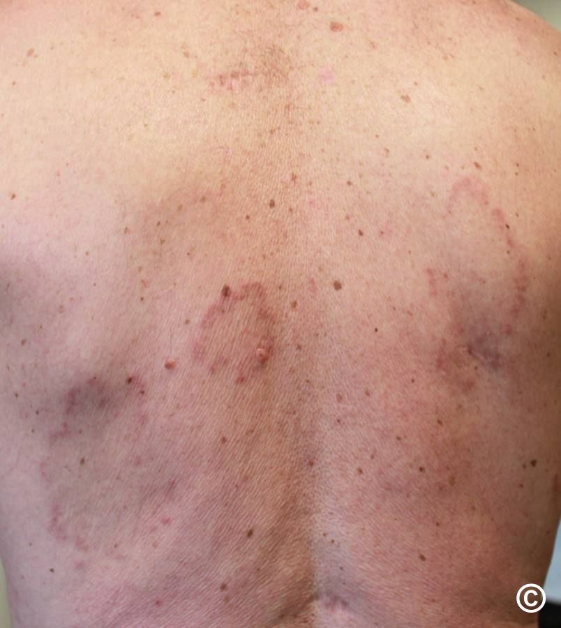Granuloma annulare