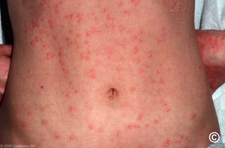 Guttate psoriasis