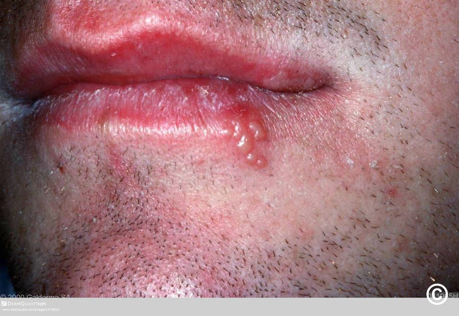 10 Symptoms of herpes You Should Never Ignore