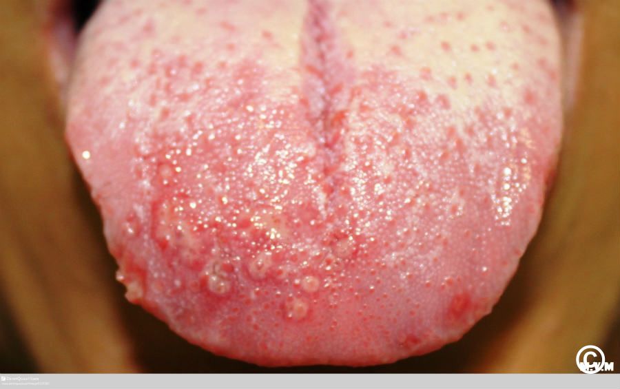 Herpes simplex infections