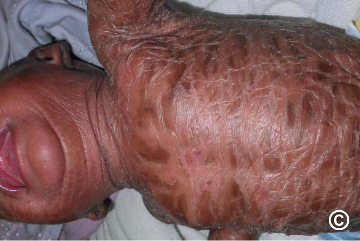Lamellar ichthyosis