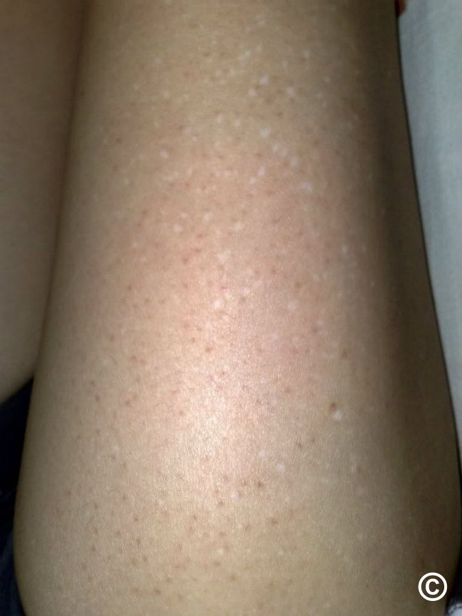 Idiopathic on sale guttate hypomelanosis