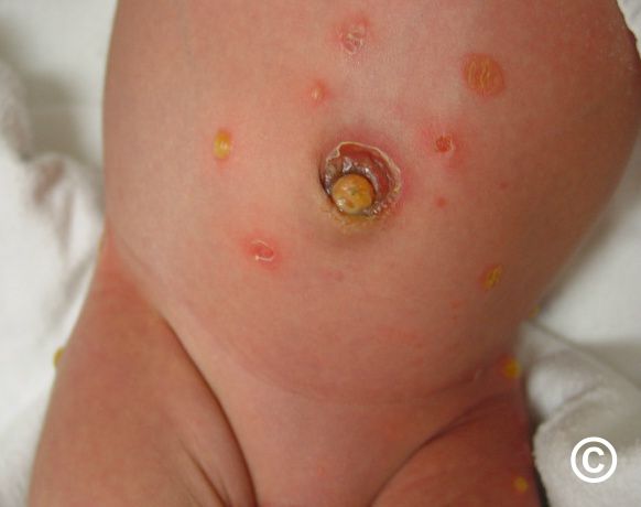 bullous impetigo in children