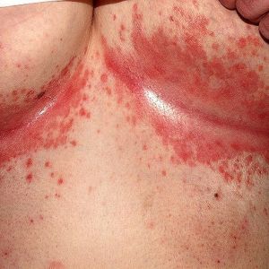 Intertrigo: Rash under Breasts - Symptoms, Causes, How to Prevent & Tr –  Carmesi