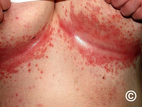 Intertrigo Symptoms, Intertrigo Rash Treatment, Anti Redness