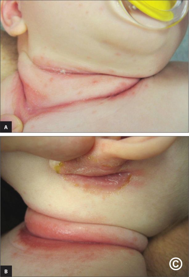 PDF) Necrotizing Cutaneous Fungal Infection of the Breast in a